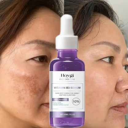 Serum eliminador de manchas oscuras, blanqueador, corrección de melanina y antipigmentación