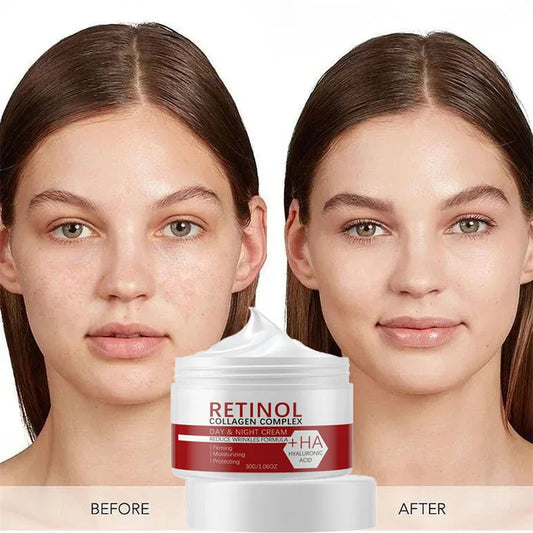 Crema blanqueadora facial y corporal con retinol, colágeno y ácido hialurónico 3 en 1, elimina manchas oscuras, melanina, acné y aclara la piel