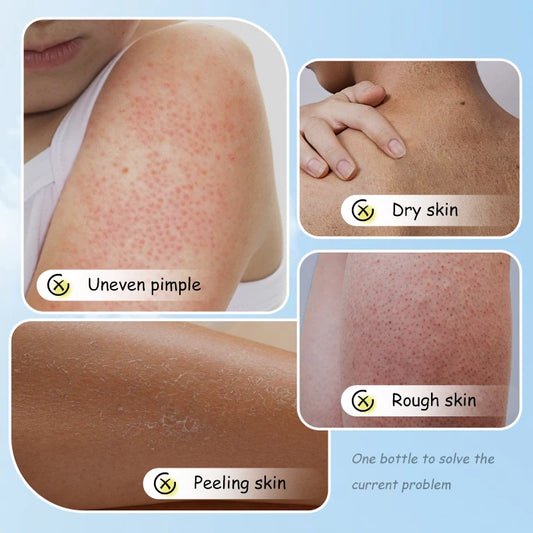 Crema hidratante reparadora de urea, queratosis, Pilaris, eliminación de pollo, limpieza de la piel y manchas de acné 100g